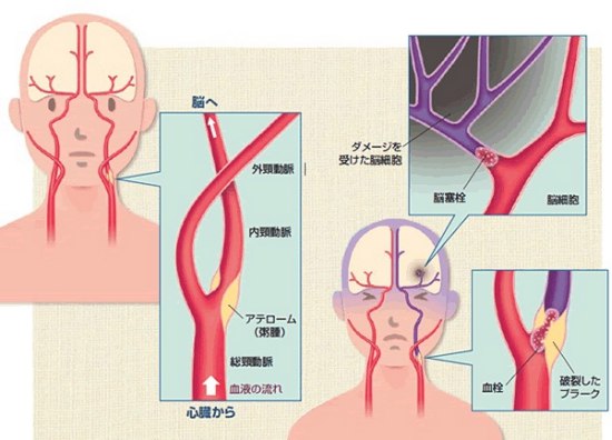 頸動脈血栓内膜剥離術（CEA）