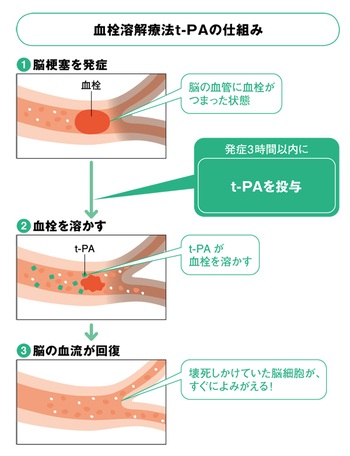 血栓溶解療法（t-PA療法）