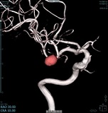 動脈瘤の画像